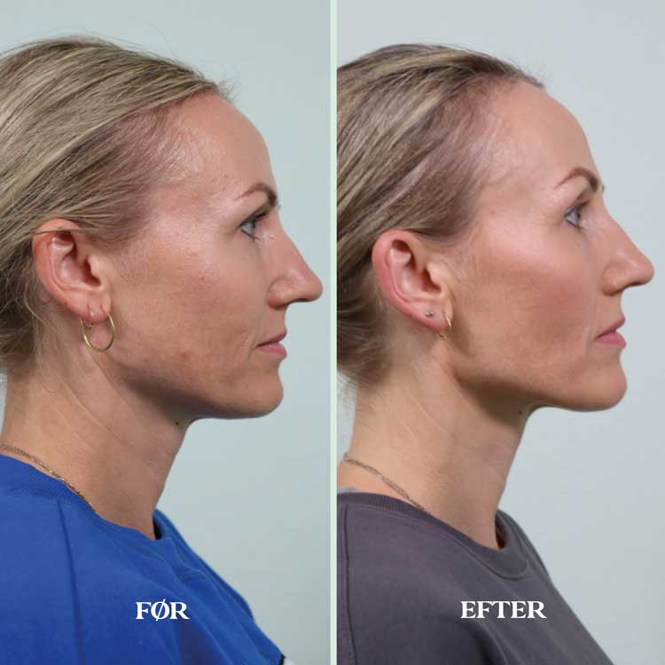 Pretty-lift-filler-under-ansigt